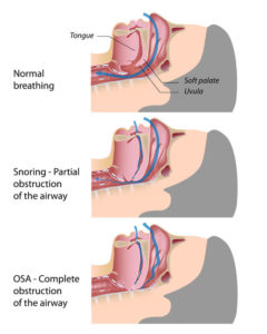 how-snoring-works-while-sleeping_img – Smiles of Virginia Family Dental ...