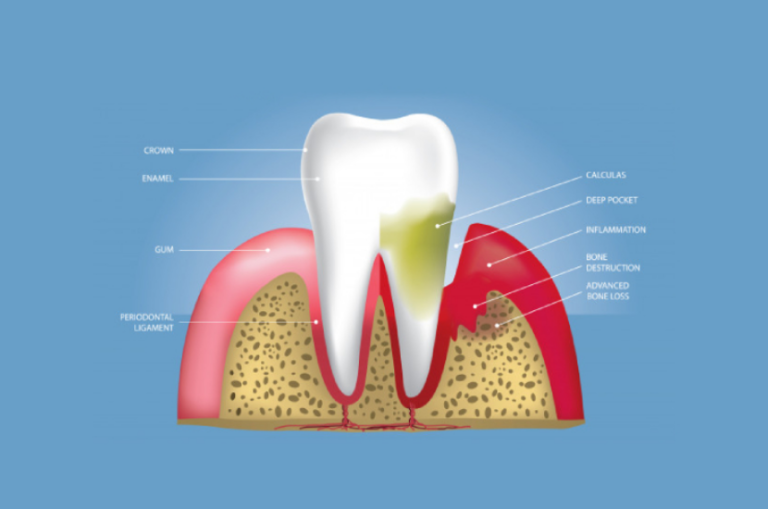 Stages of Gum Disease - An Overview